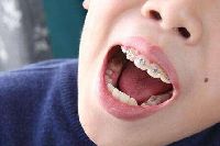 【健康解碼】矯正牙齒真的可以瘦臉嗎？